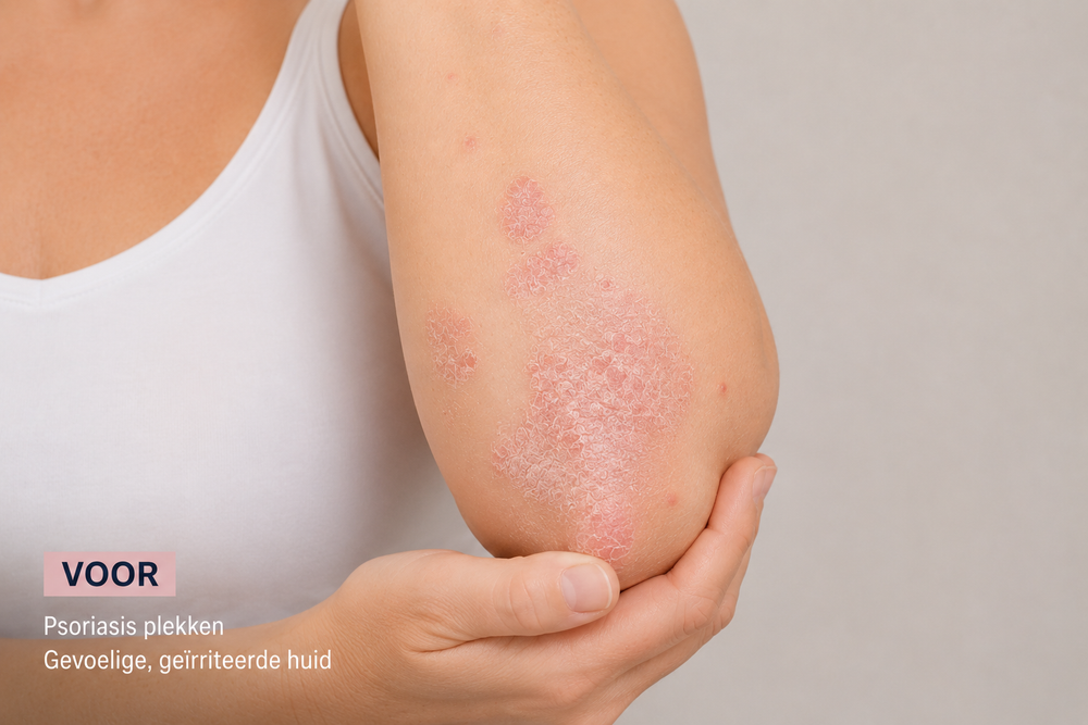 Extroderm Douchecrème – Voor: Loes